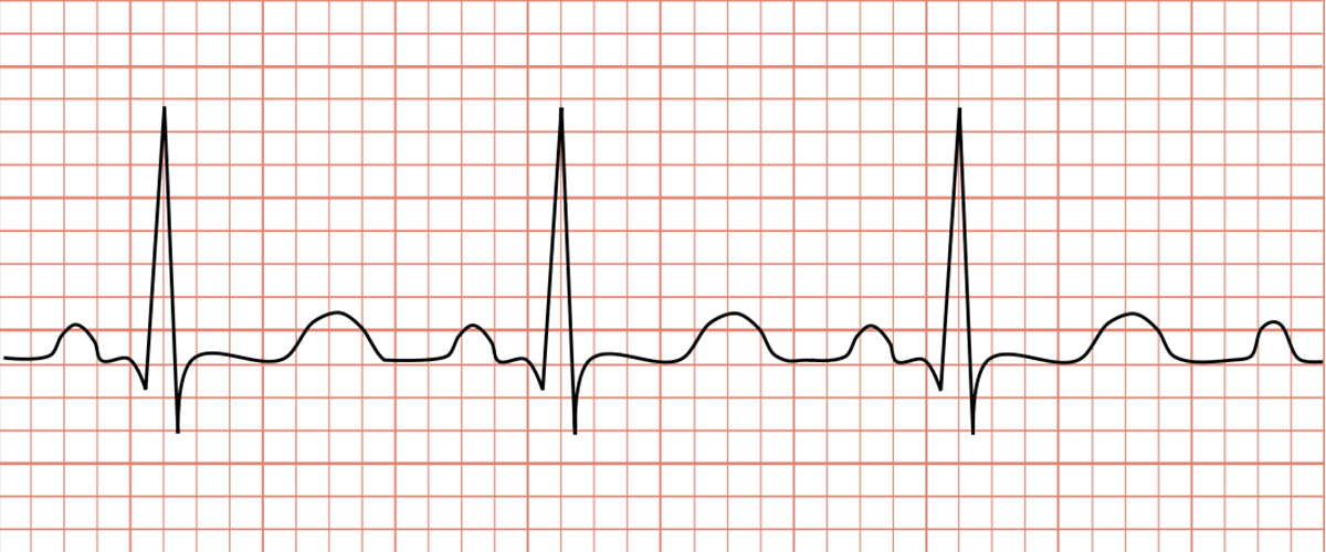 ECG read out of tachycardia heart rate