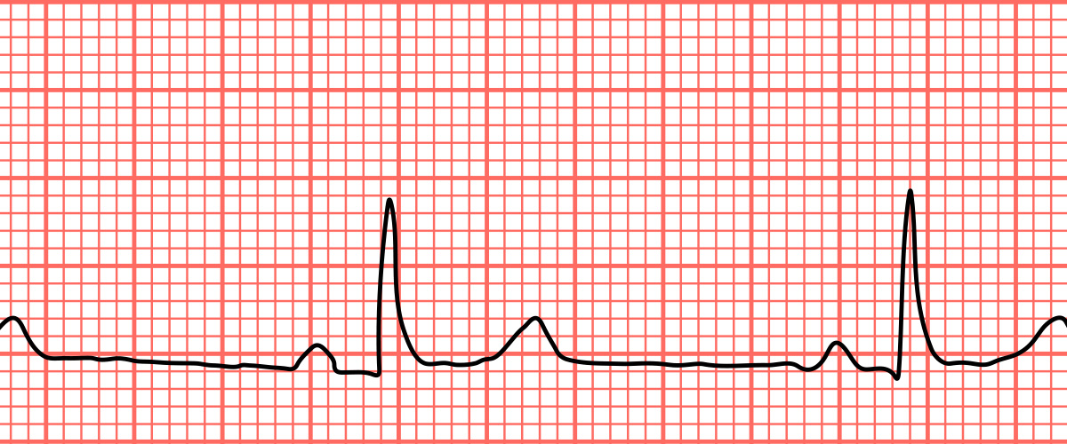 ECG read out of bradycardia heart rate