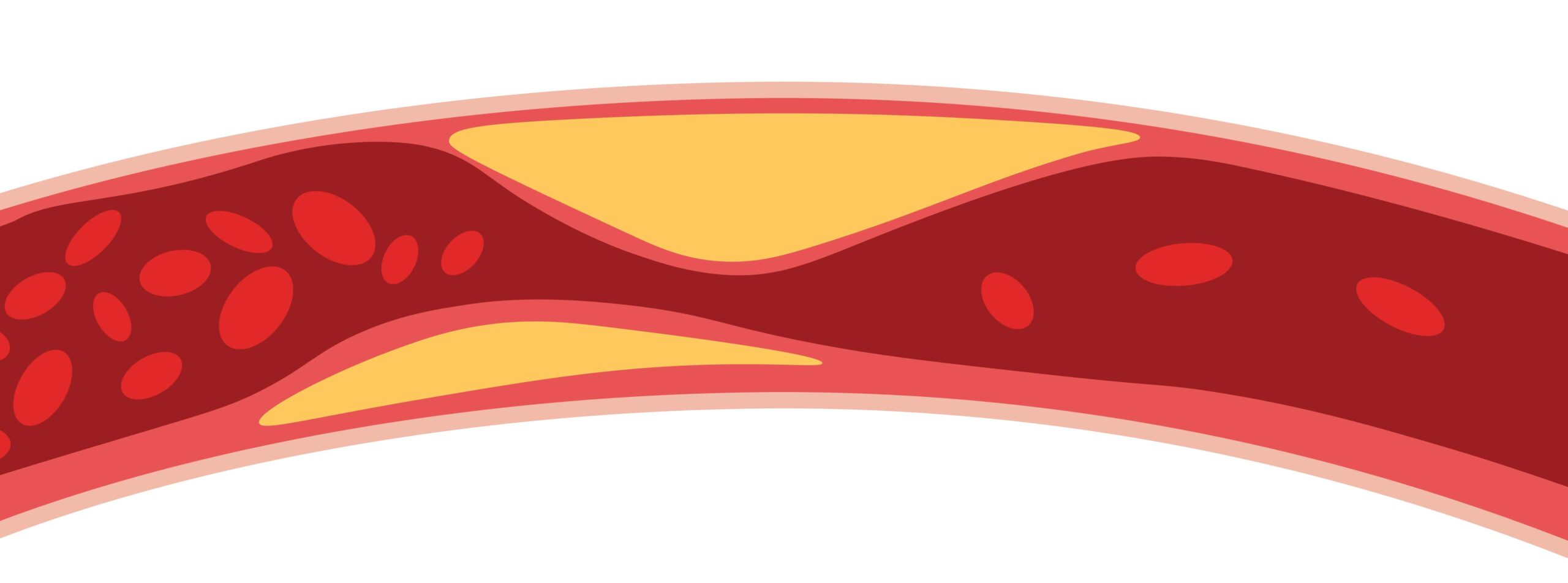 Artist rendering of a blood vein with high levels of cholesterol