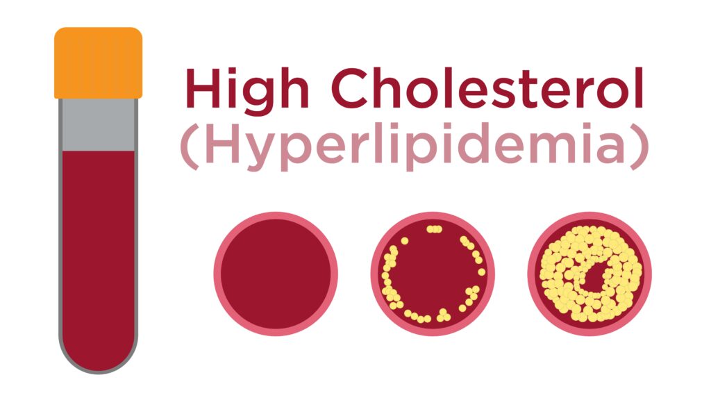 High Cholesterol Hyperlipidemia Cardiogram 2546